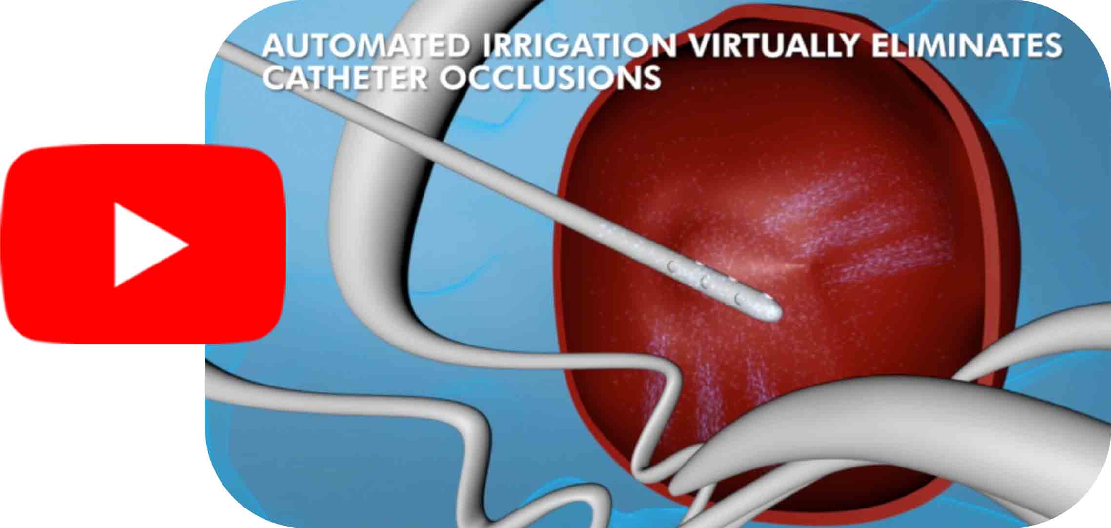 Neurological Fluid Management Technology - IRRAS IRRAFLOW you tube link