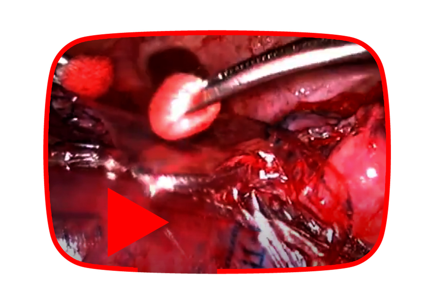 P9 - Pic 4 Thoracic (including Thoracoscopic) Surgery